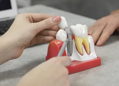 Can You Make Dental Implants Whiter?