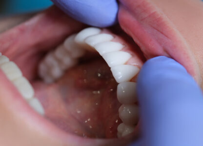 Can You Have a Veneer on the Top of an Implant?