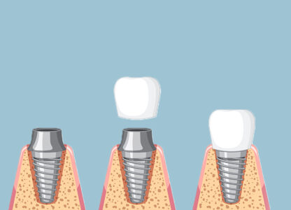 Dental Implants: A Permanent Smile Makeover for Missing Teeth