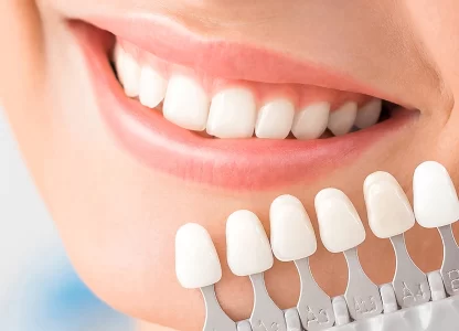 Everything You Need to Know About Dental Veneers