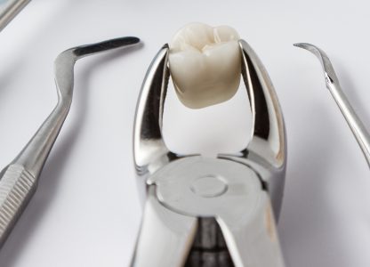 Top 5 Signs You Might Need a Tooth Extraction